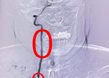 55 жастағы науқасқа омыртқа артериясын стенттеу отасы жасалды.