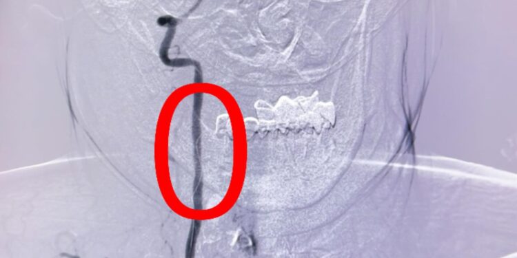 55 жастағы науқасқа омыртқа артериясын стенттеу отасы жасалды.