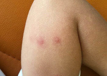 Түркістан қалалық балалар ауруханасы.Инсекттік аллергия.