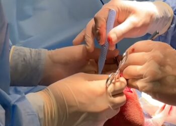 Бүгін урология бөлімшесінде жоспарлы оталар сәтті өтті.