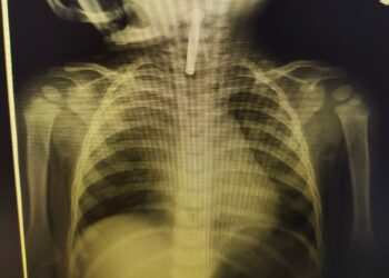 Түркістан облыстық балалар ауруханасының дәрігерлері 1 жасар баланың өмірін құтқарып қалды.