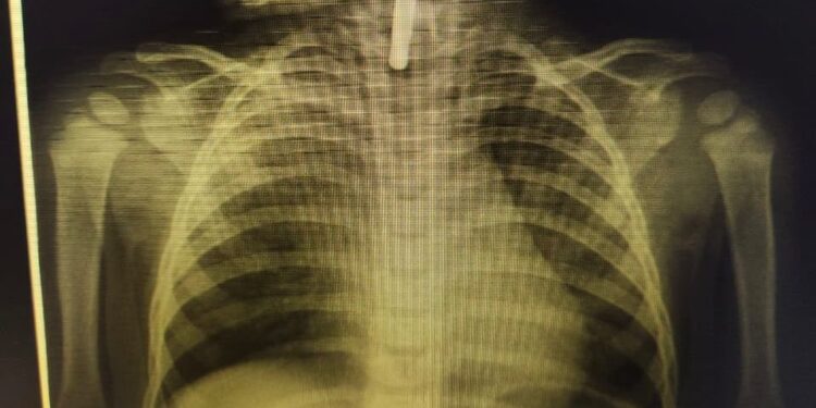 Түркістан облыстық балалар ауруханасының дәрігерлері 1 жасар баланың өмірін құтқарып қалды.